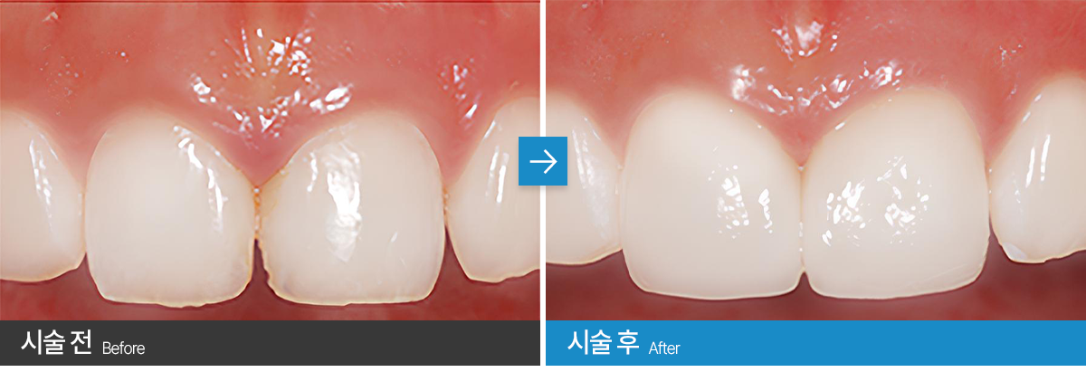 무삭제 라미네이트